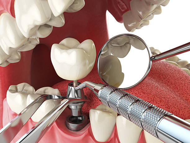 Best Emergency Dental Care for Broken or Chipped Teeth in Chester, IL